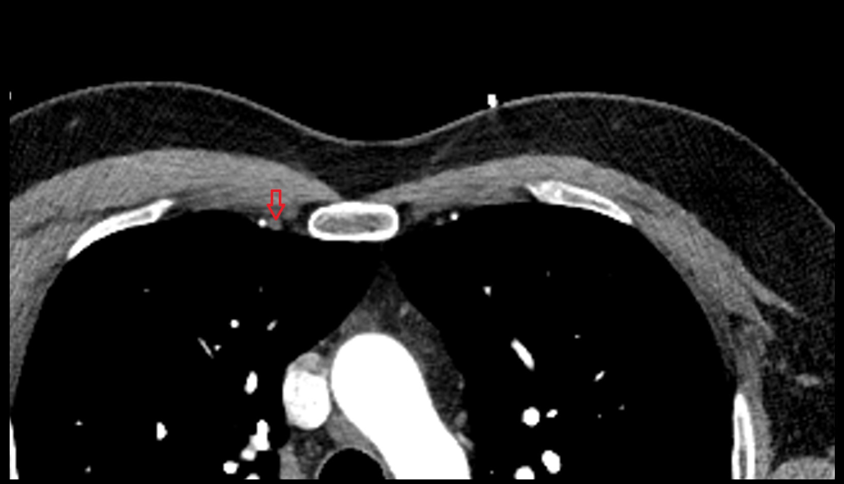Right Internal Thoracic Veins  Anatomy ct axial