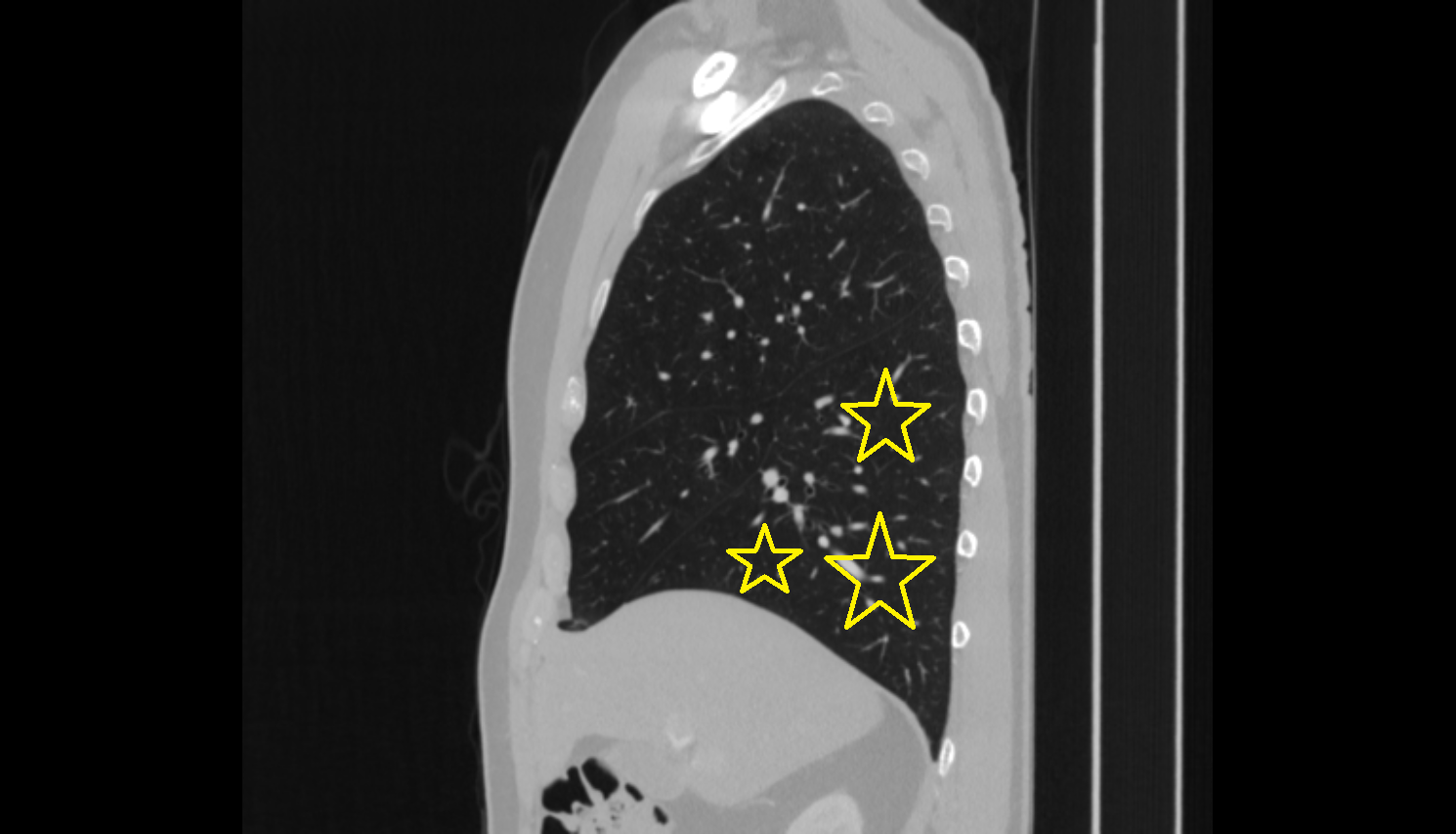 Right Lung Inferior Lobe_ Anatomy, Location and Imaging Appearance CT anatomy image -img-00000-00000