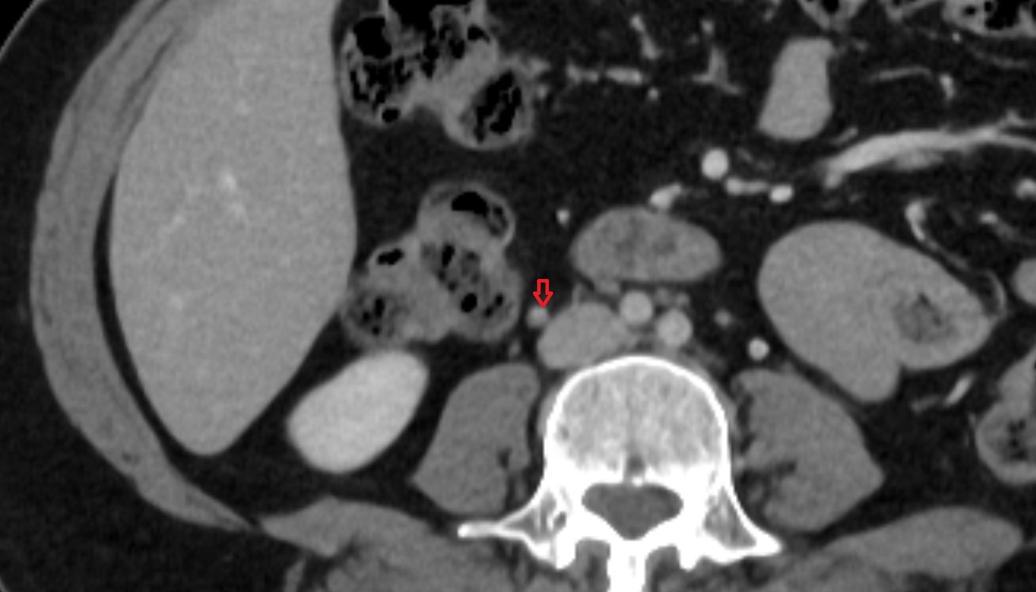 Right Ovarian Vein  CT axial  anatomy  image -img-00000-00000