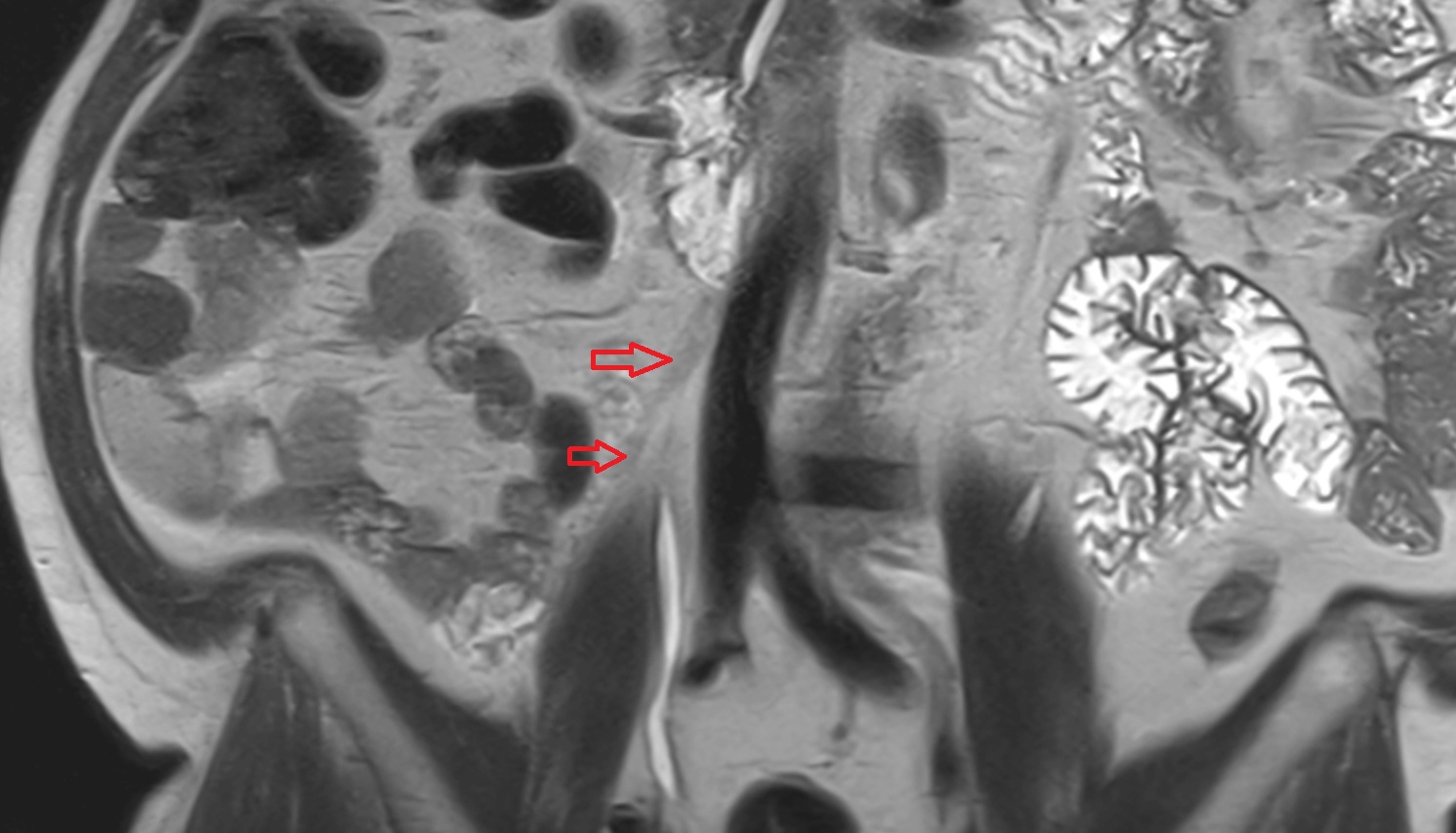 Right Ovarian Vein   MRI coronal  anatomy  image -img-00000-00000