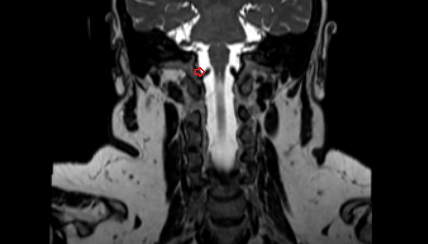 Right Vertebral Artery (Intracranial Part)  mri coronal image -img-00000-00000_00001