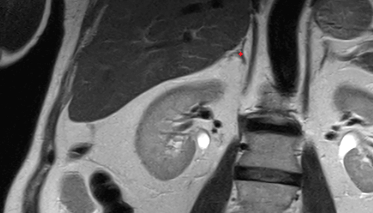 Right adrenal gland  MRI coronal  image anatomy  image -img-00000-00000
