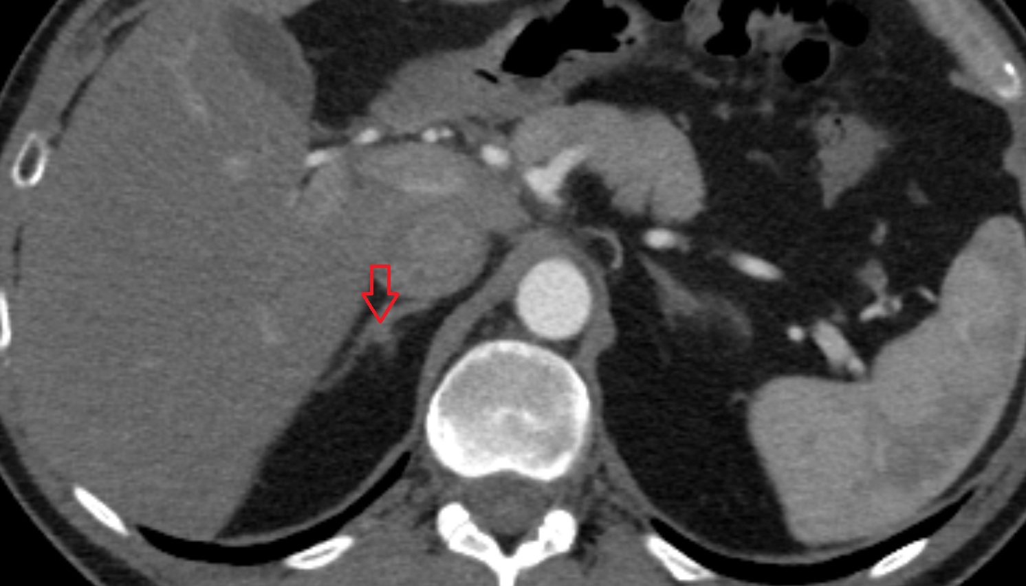 Right  adrenal gland  anatomy CT axial  image -img-00000-00000