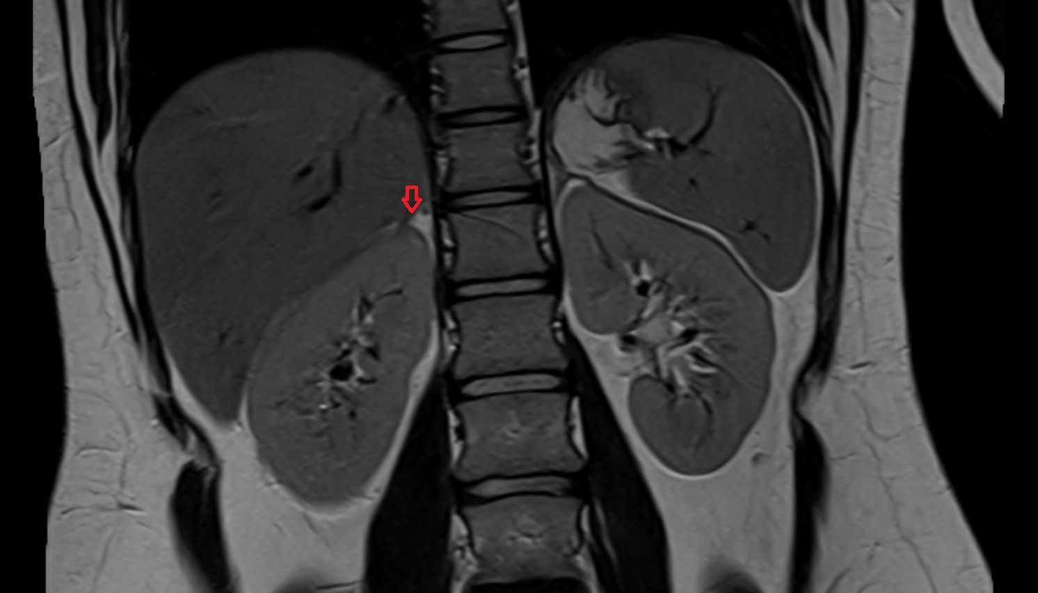 Right  adrenal gland  anatomy  MRI coronal  image -img-00000-00000
