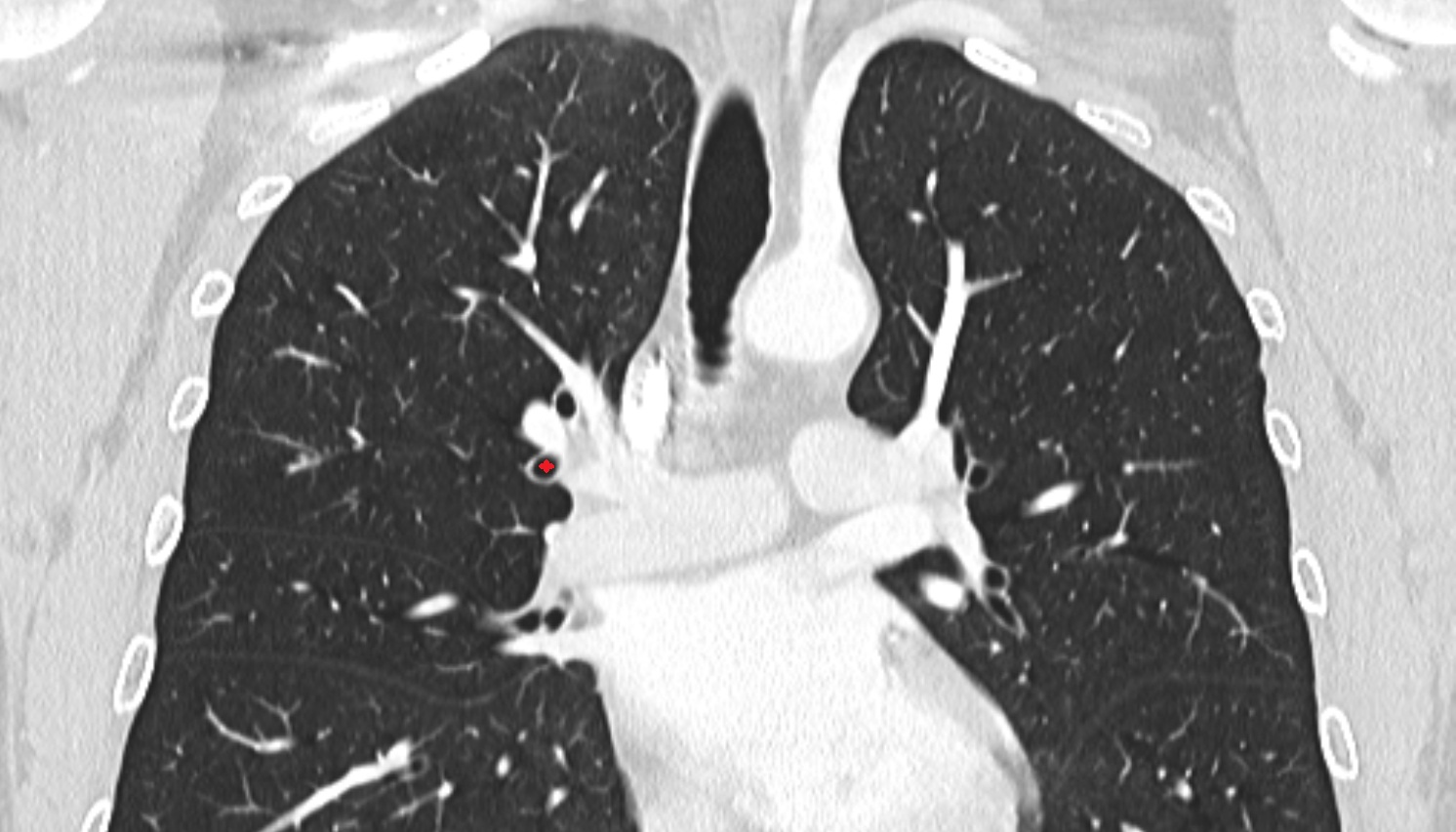 Right anterior segmental bronchus (B3)  anatomy  CT coronal  image -img-00000-00000