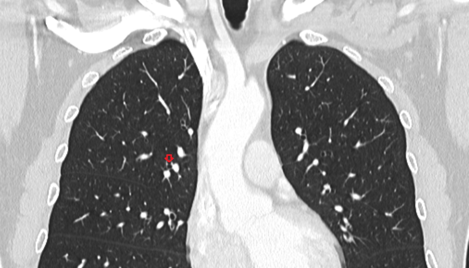 Right anterior segmental bronchus (B3)  anatomy  CT coronal  image -img-00000-00000_00001