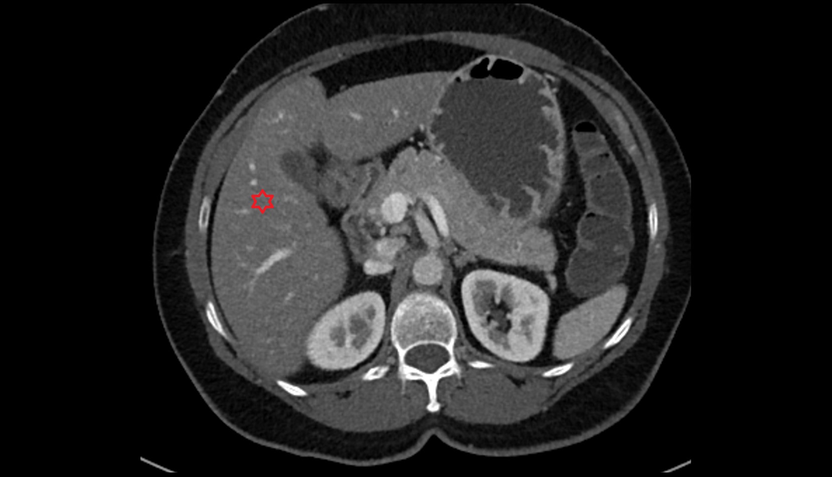Liver right anteroinferior segment — Segment V CT image