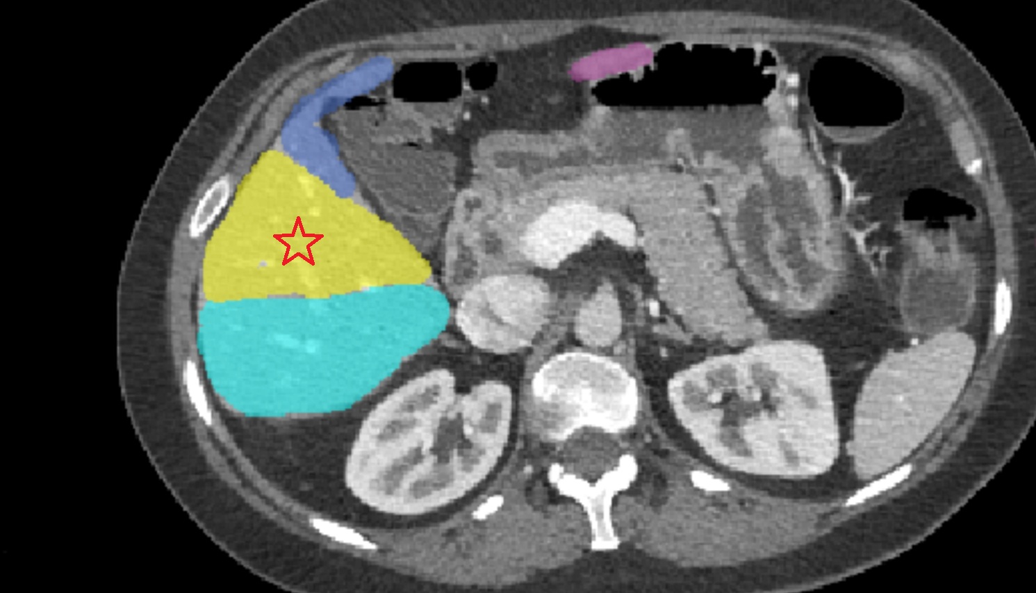 Liver right anteroinferior segment — Segment V CT image   CT  axial  anatomy  image
