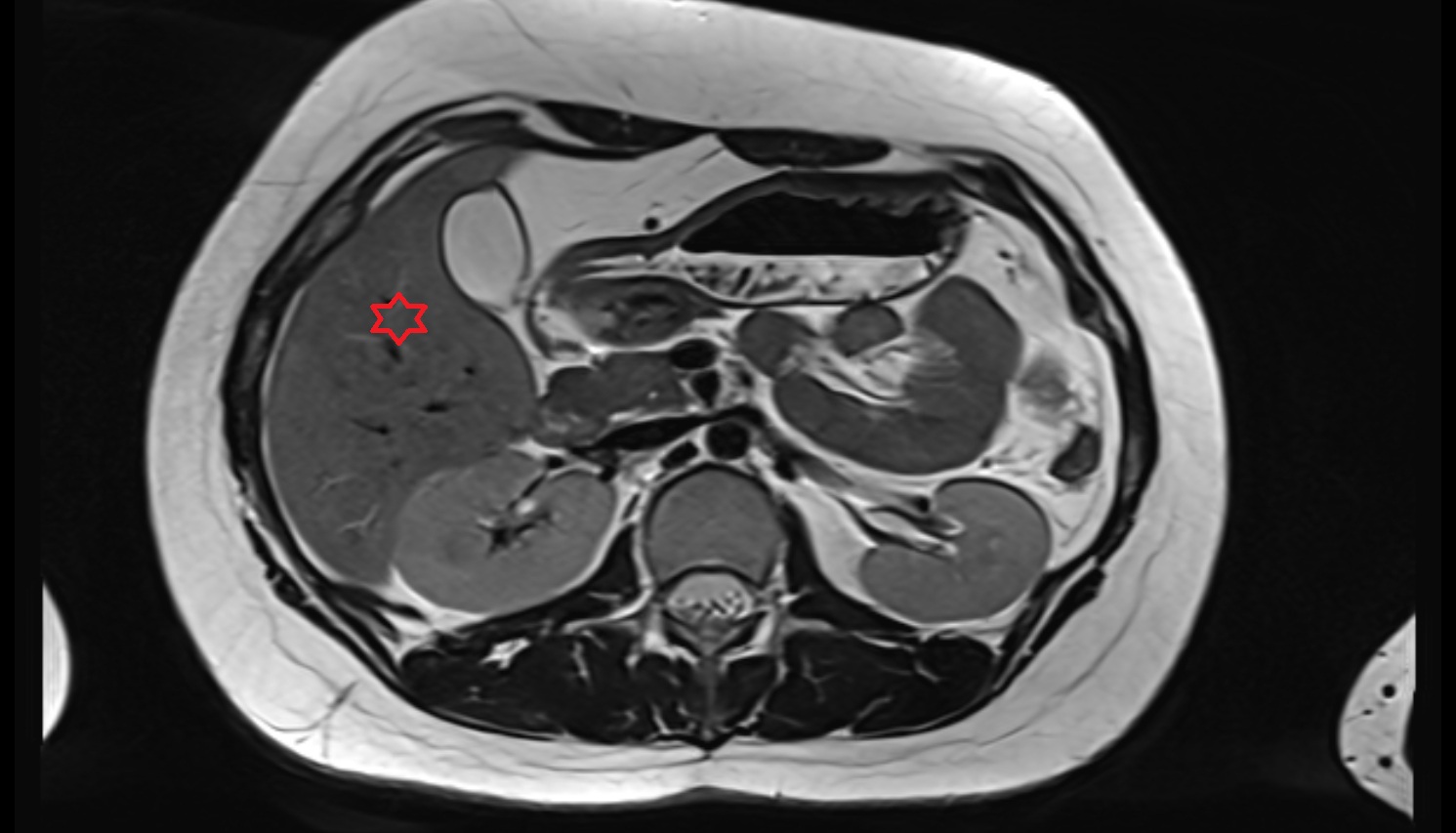 Liver right anteroinferior segment — Segment V  MRI  axial  anatomy  image