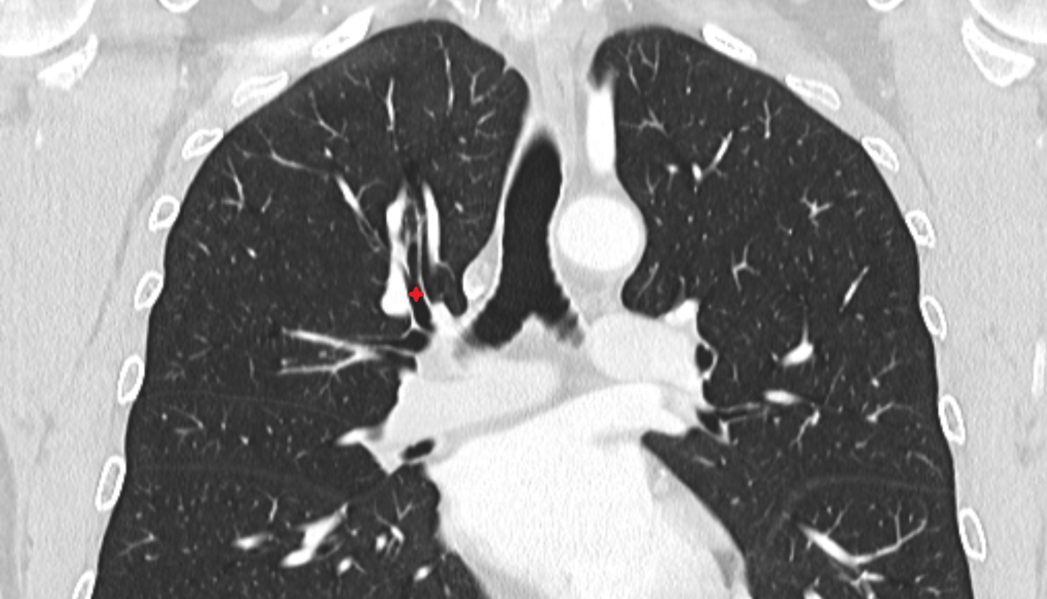 Right apical segmental bronchus (B1)  anatomy  CT coronal  image -img-00000-00000