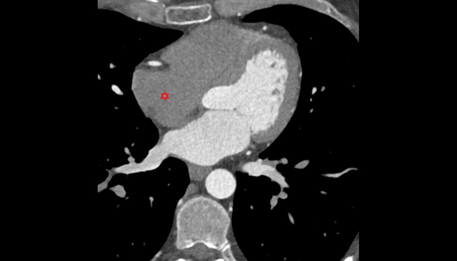 Right atrium anatomy  CT axial image -img-00000-00000