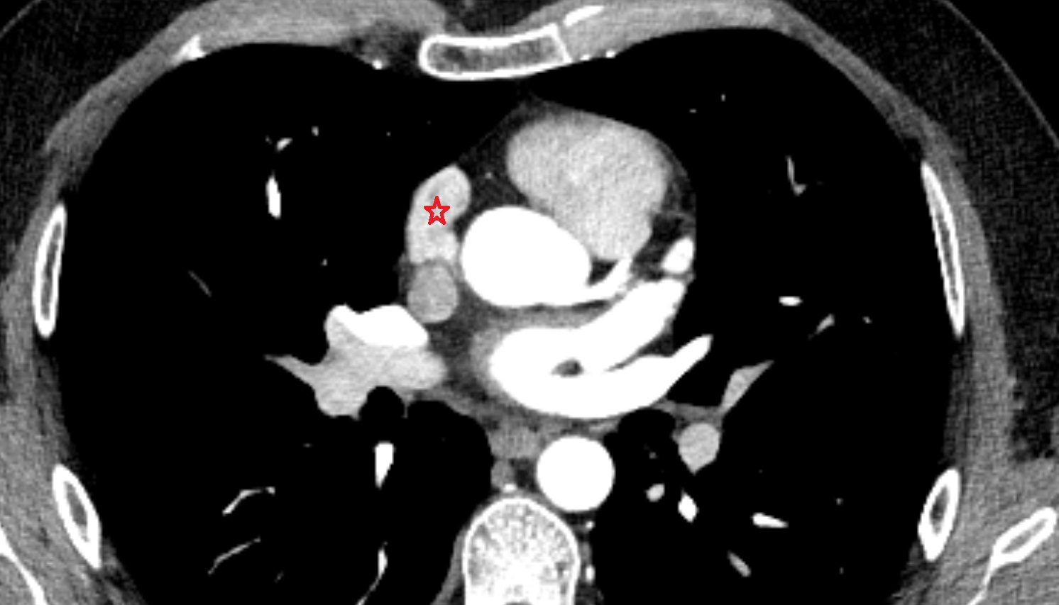 Right auricle of heart  CT axial   image -img-00000-00000