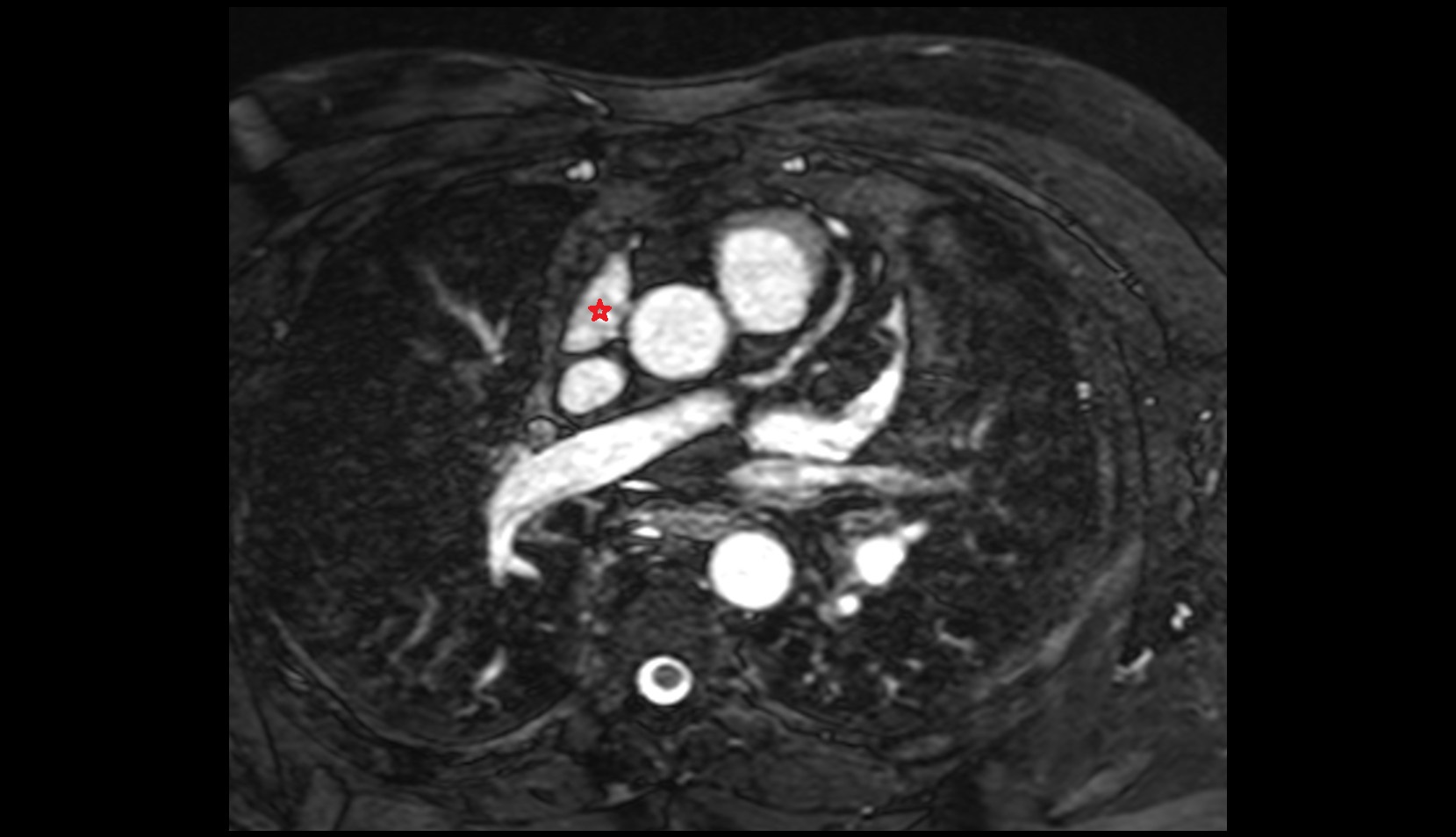 Right auricle of heart mri image