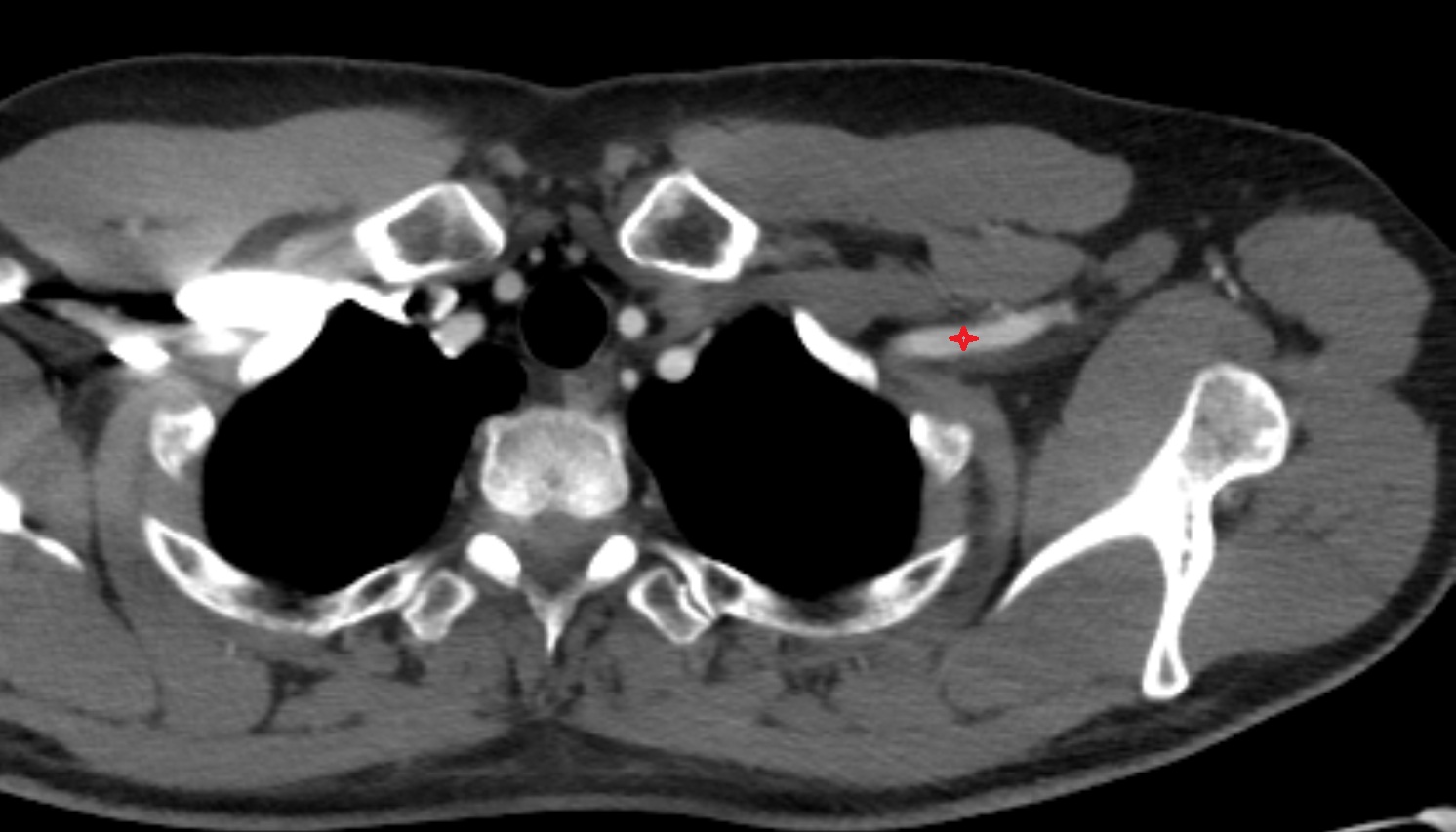 Right axillary artery anatomy CT  AXIAL  image -img-00000-00000