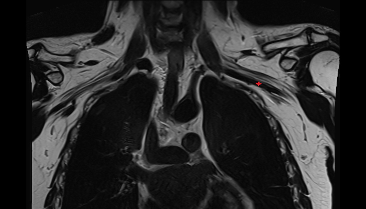 Right axillary artery anatomy  MRI coronal  image -img-00000-00000