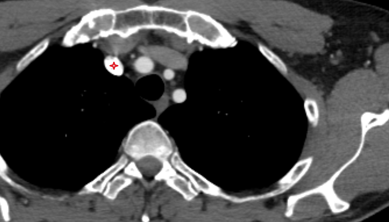 Right brachiocephalic vein anatomy  CT axial  image -img-00000-00000