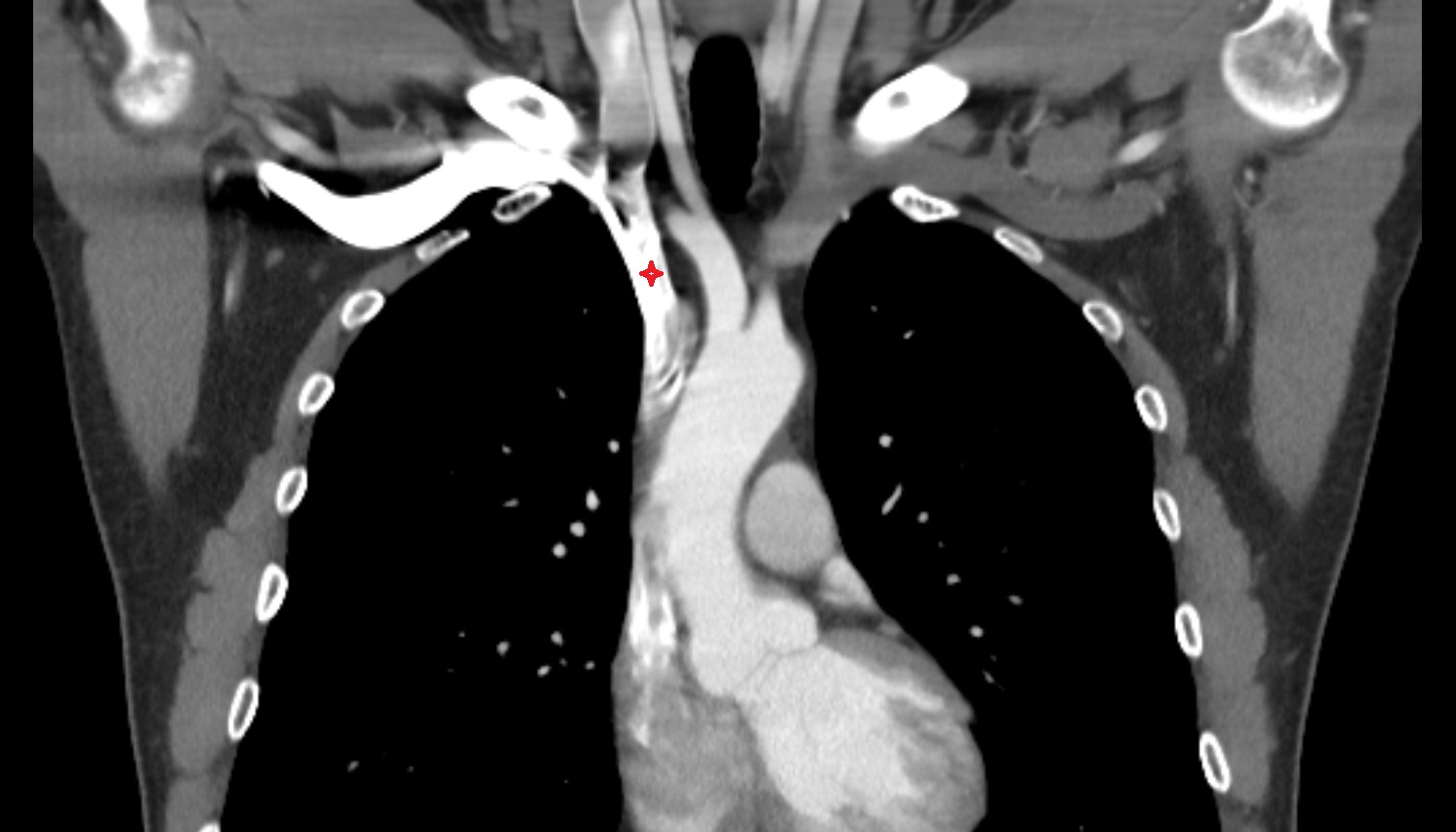 Right brachiocephalic vein anatomy  ct coronal  image -img-00000-00000