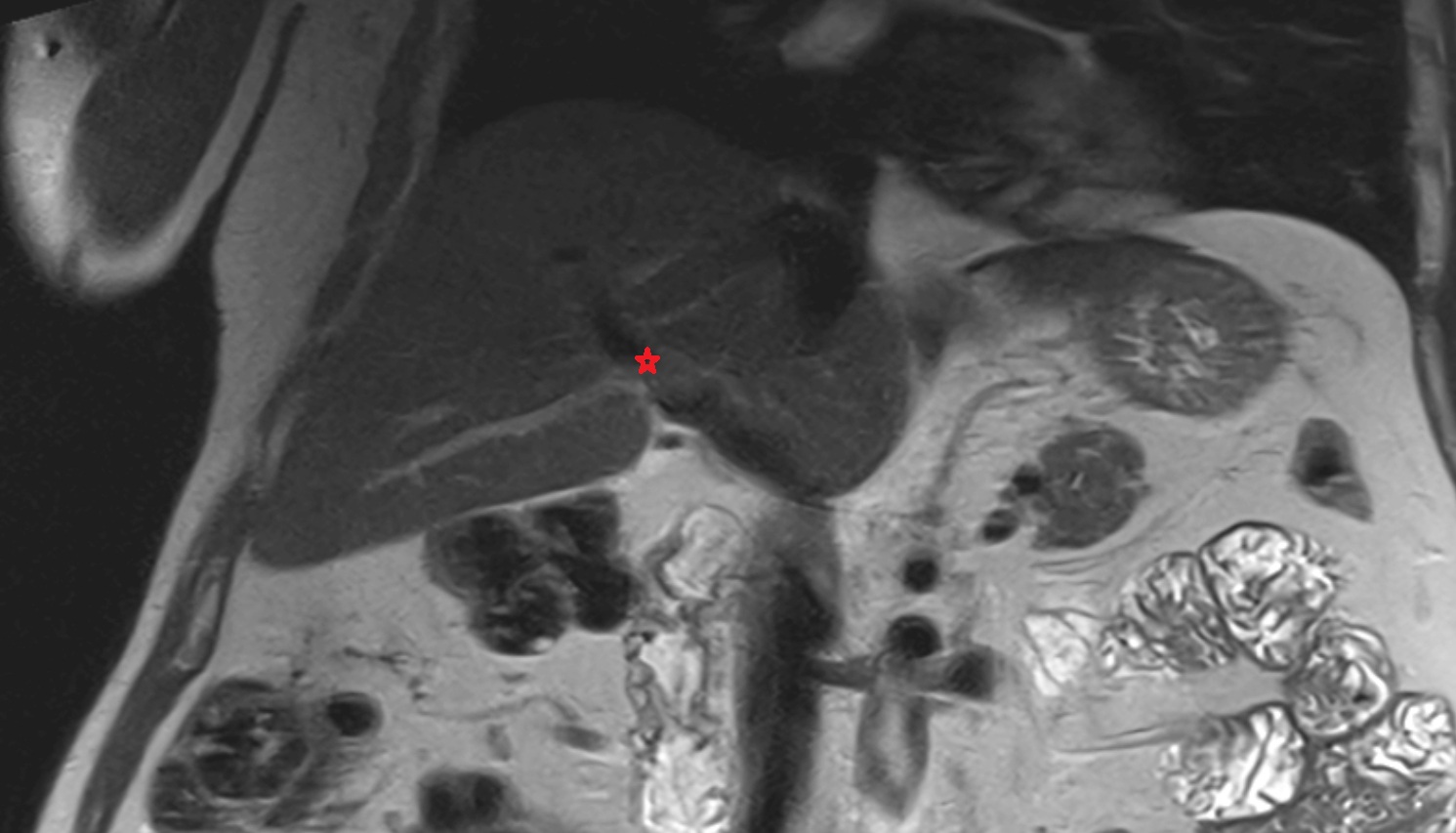 Right branch of hepatic portal vein MRI coronal  anatomy  image -img-00000-00000