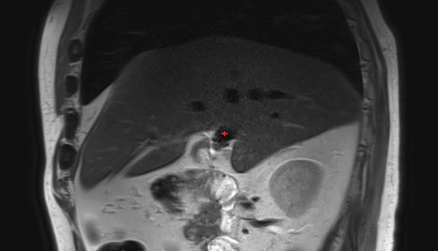 Right branch of hepatic portal vein MRI sag anatomy  image -img-00000-00000