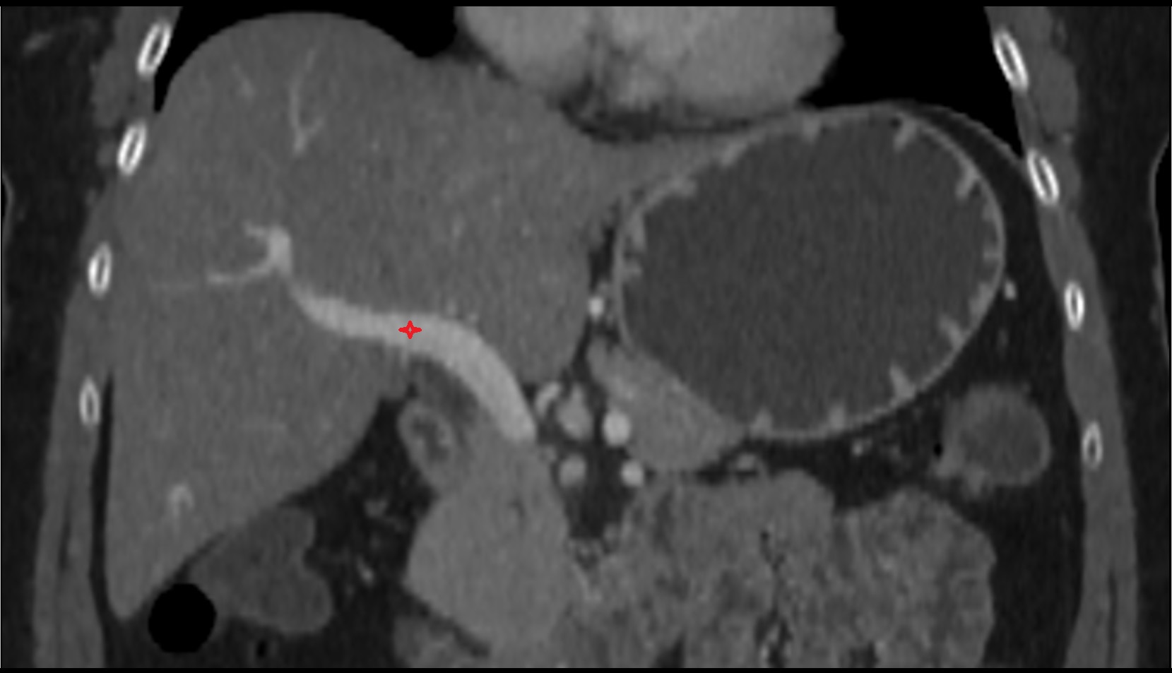 Right branch of hepatic portal vein ct coronal