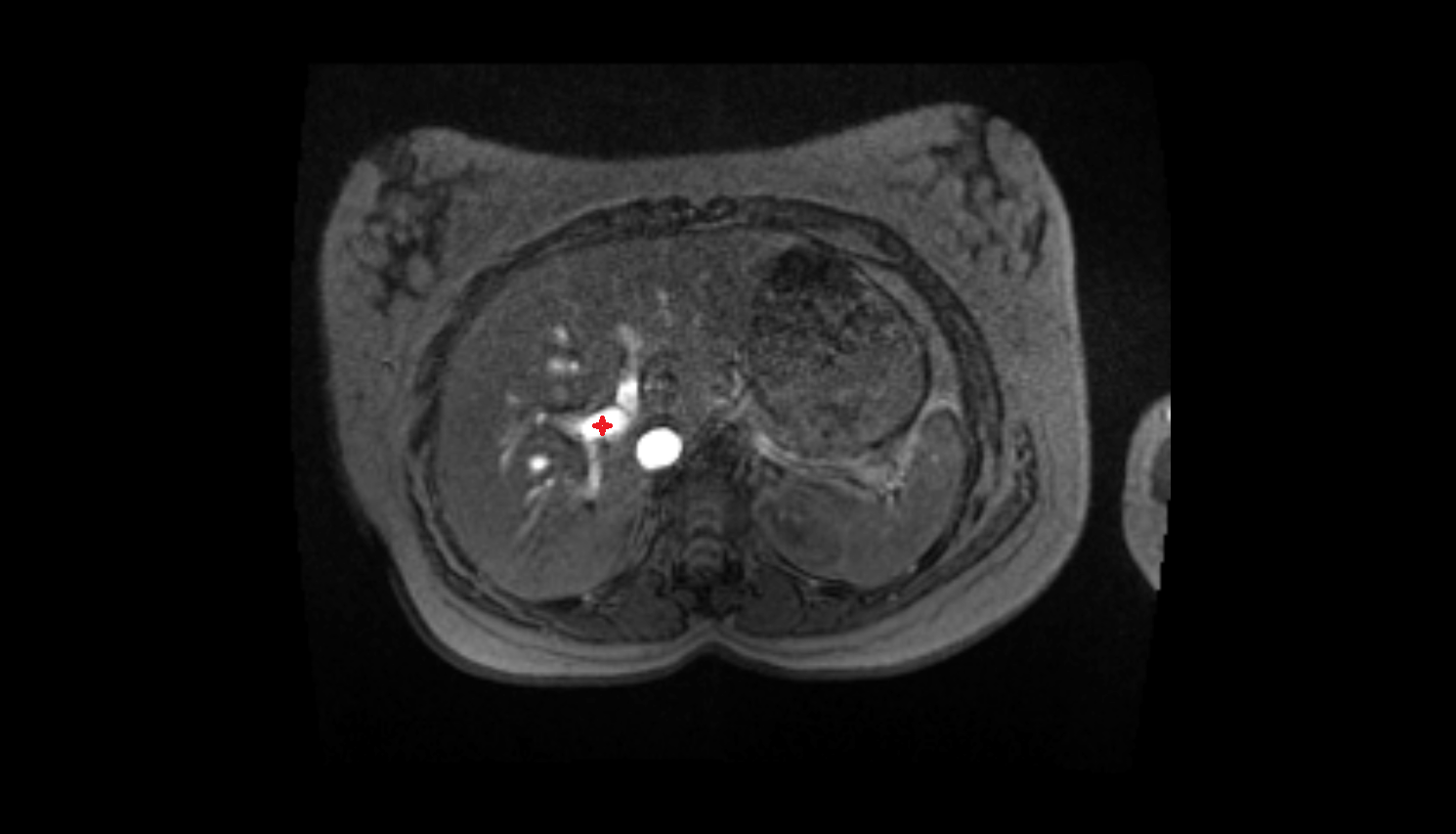 Right branch of portal vein  MRI axial