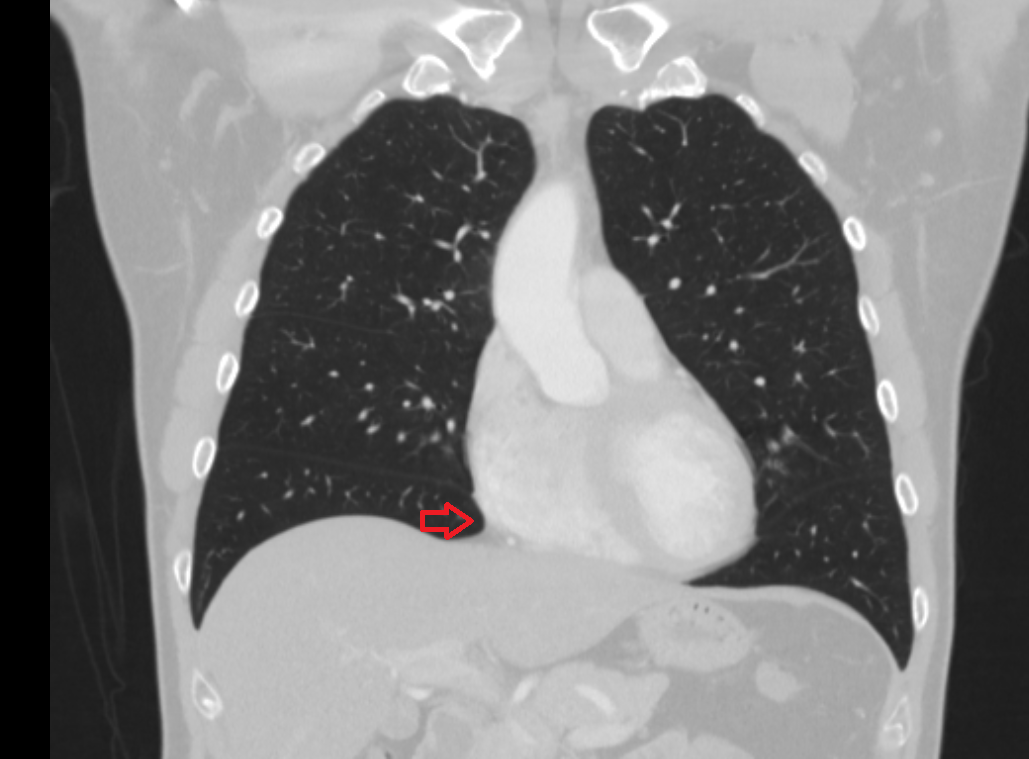 Right cardiophrenic angle ct Anatomy, Location and Imaging Appearance
