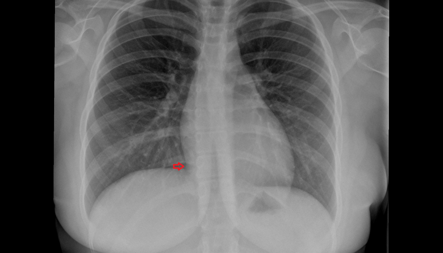 Right cardiophrenic angle x ray Anatomy, Location and Imaging Appearance  -img-00000-00000