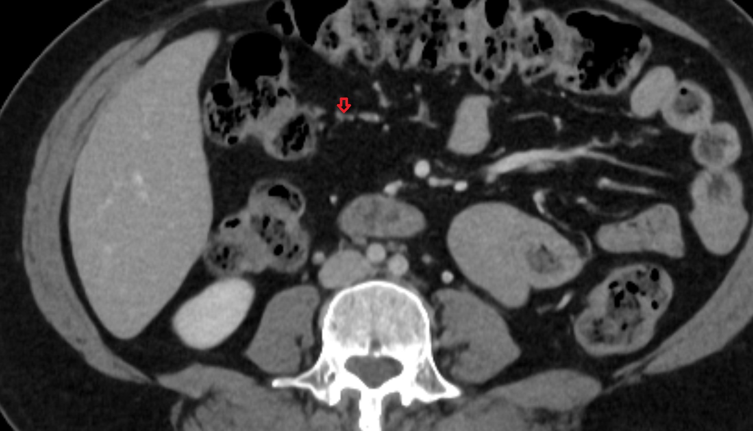 Right colic artery CT axial  anatomy  image -img-00000-00000