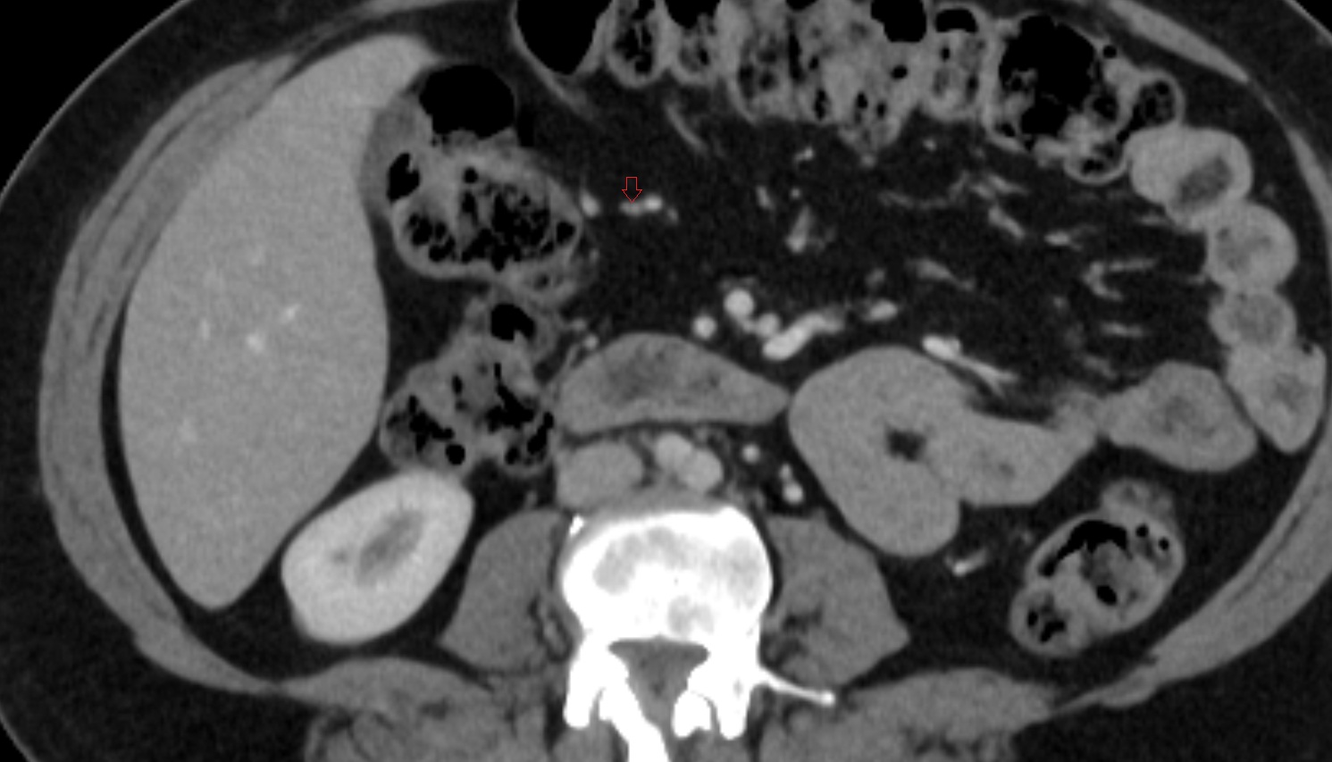 Right colic artery CT axial  anatomy  image -img-00000-00000_00001