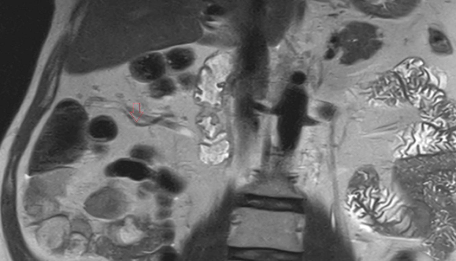 Right colic artery MRI coronal  anatomy  image -img-00000-00000