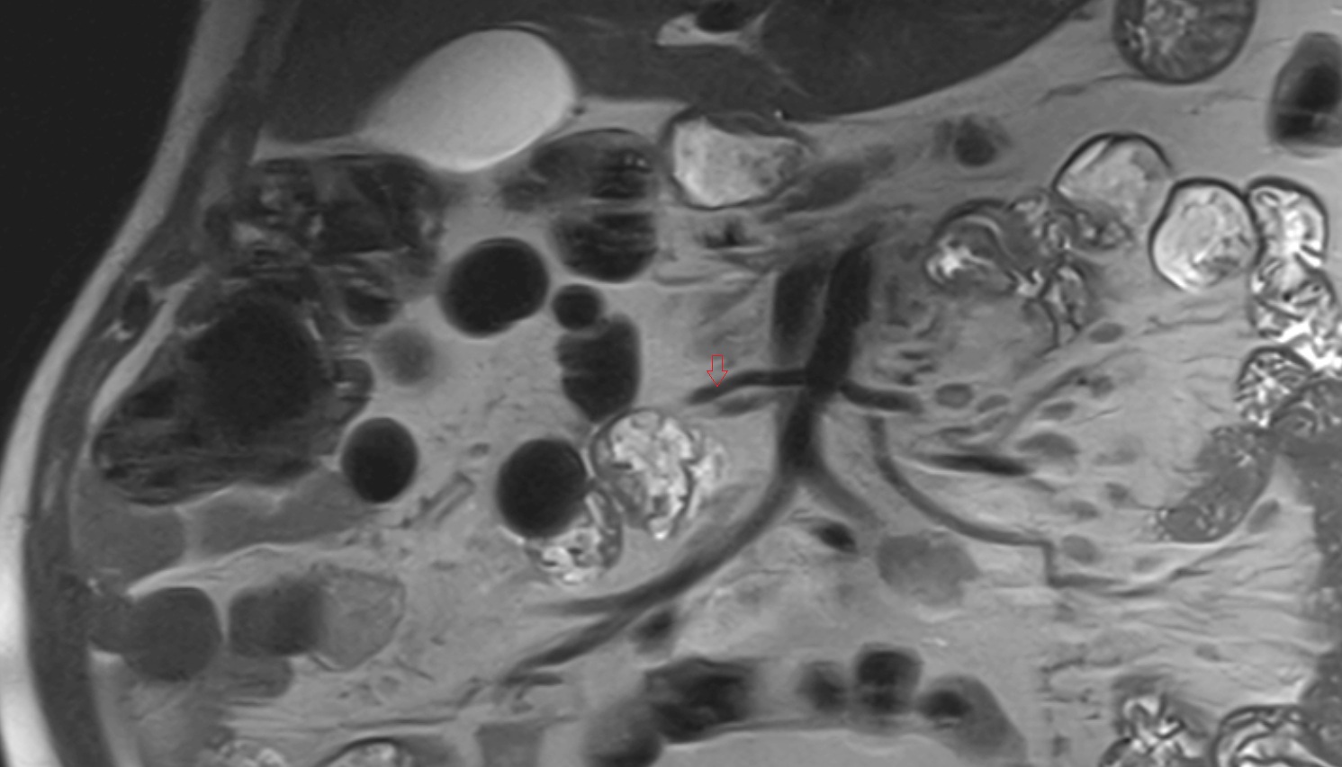 Right colic artery MRI coronal  anatomy  image -img-00000-00000_00001