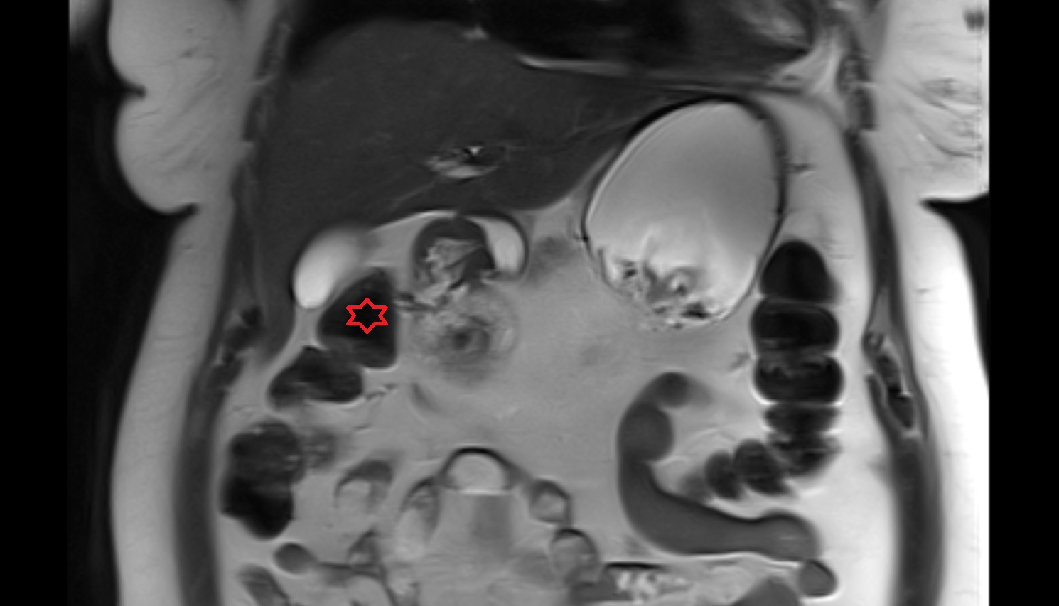Right colic flexure (hepatic flexure) MRI coronal anatomy  image-img-00000-00000