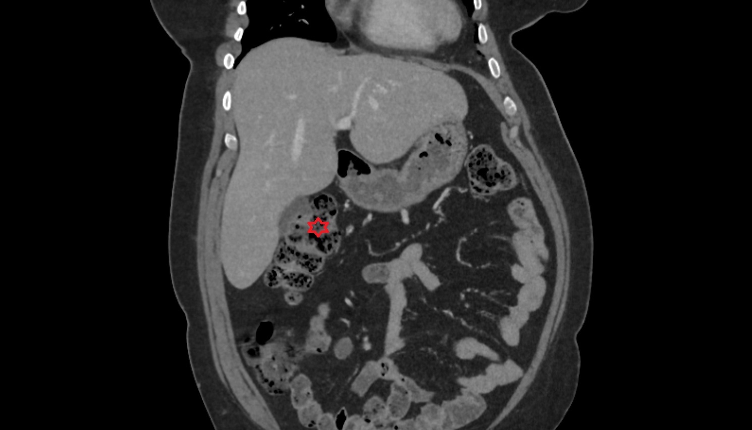 Right colic flexure (hepatic flexure)  ct  coronal anatomy  image-img-00000-00000