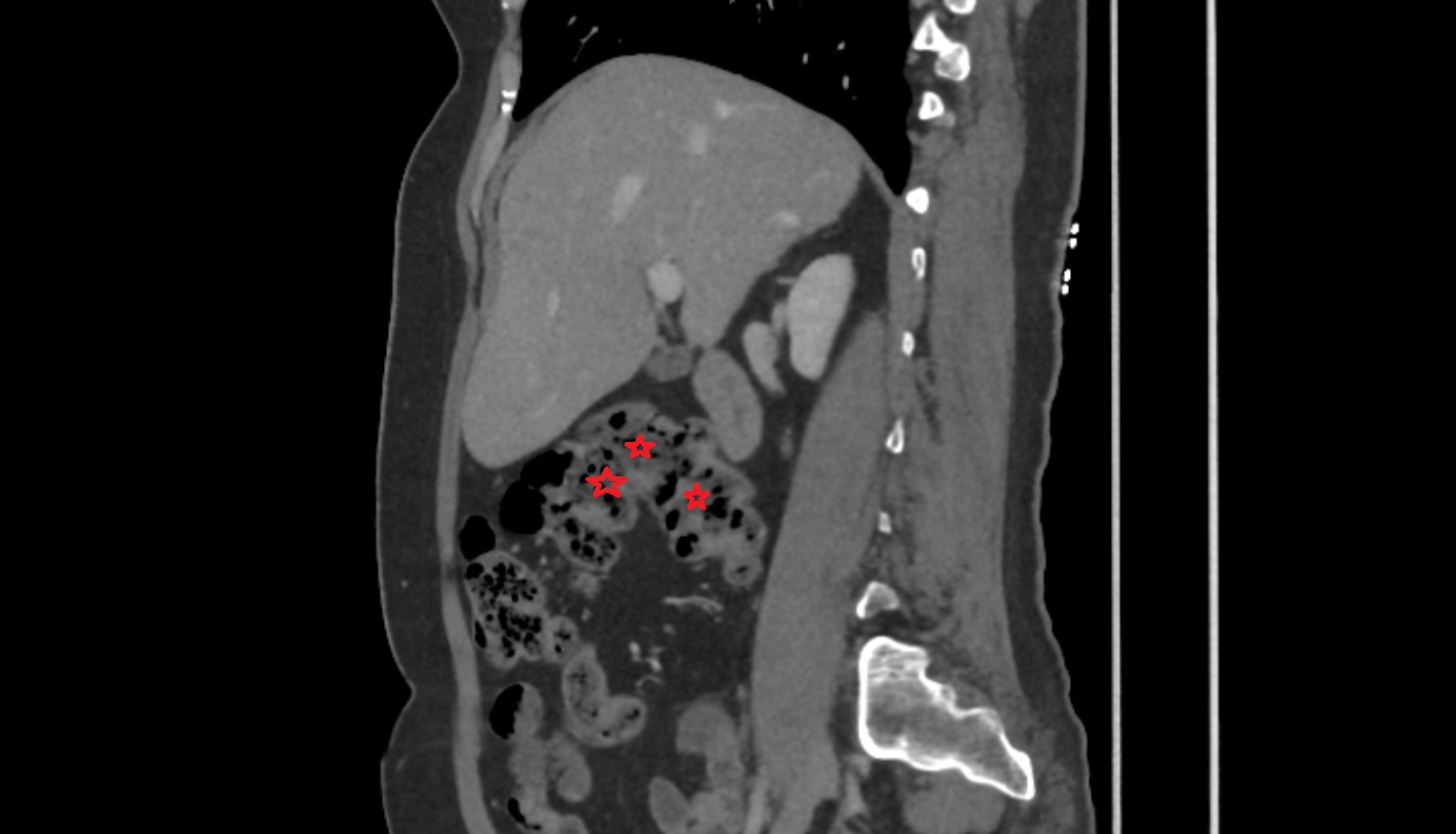 Right colic flexure (hepatic flexure)  ct  sagittal  anatomy  image-img-00000-00000