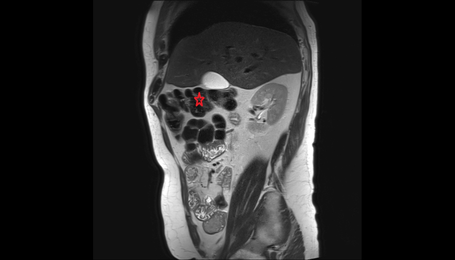 Right colic flexure (hepatic flexure)  mri  sagittal  anatomy  image-img-00000-00000