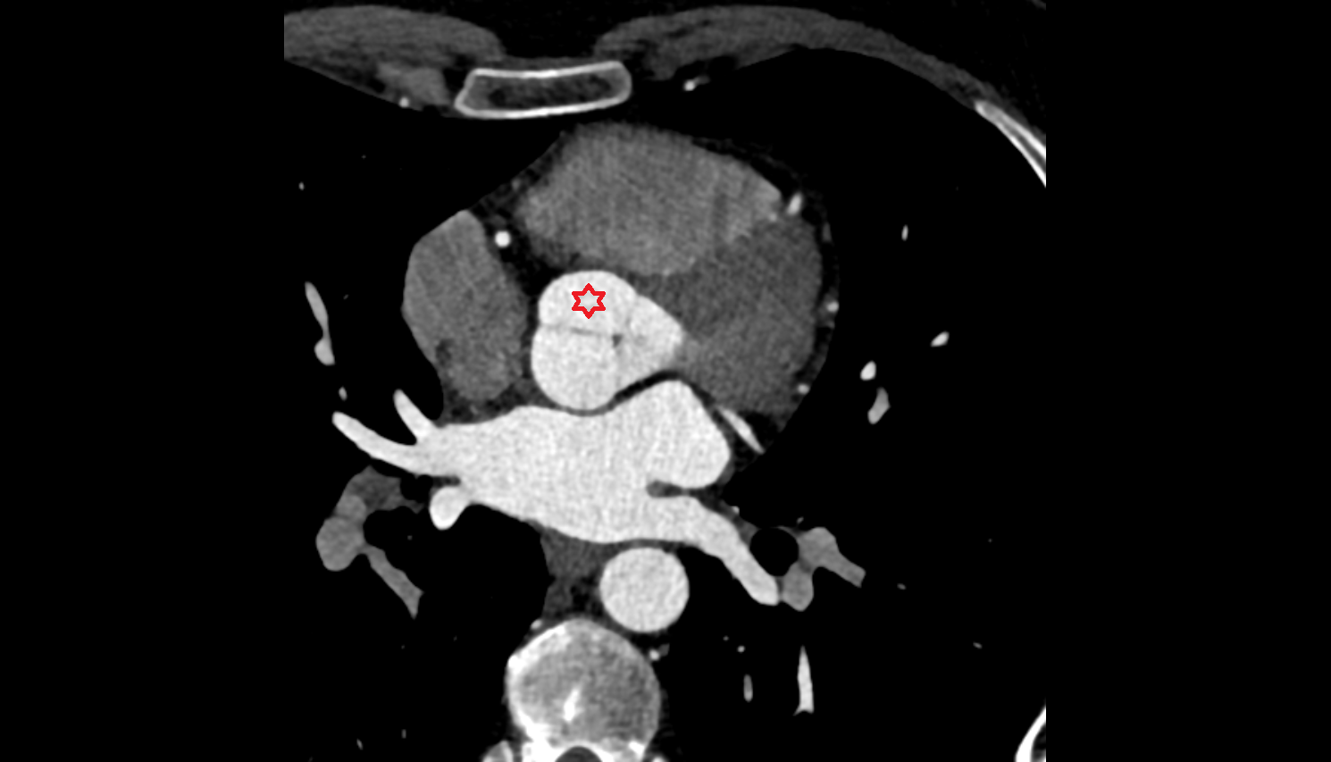 Right coronary aortic sinus CT axial  image-img-00000-00000