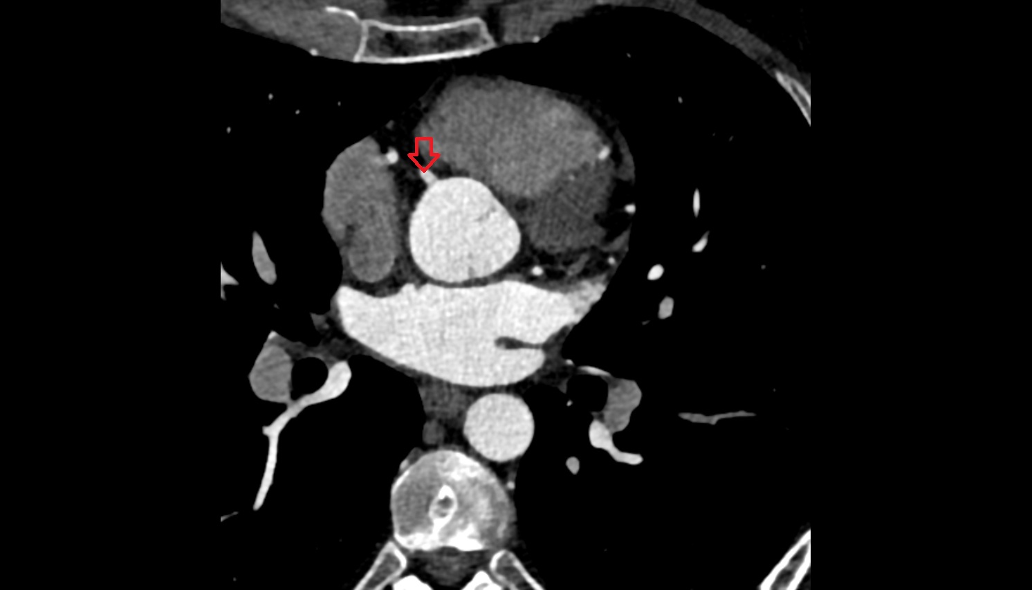 Right coronary artery (RCA)   anantomy  CT  axial image -img-00000-00000
