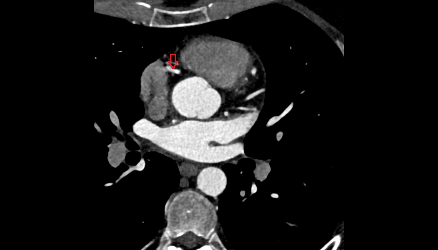 Right coronary artery (RCA)   anantomy  CT  axial image -img-00000-00000_00001