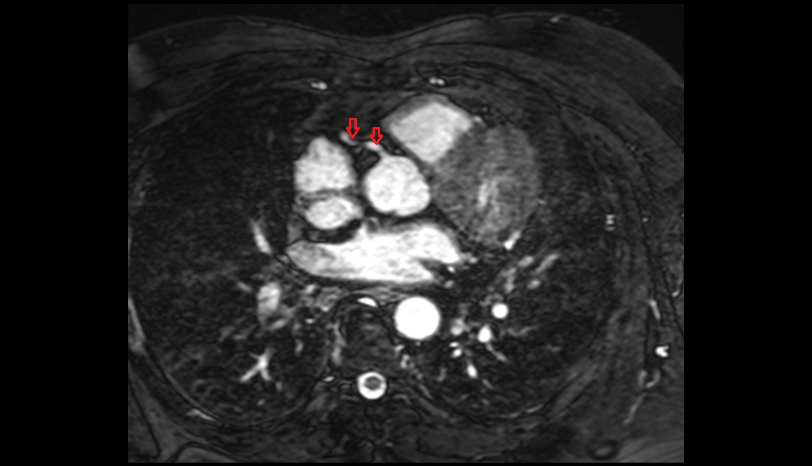 Right coronary artery (RCA) mri axial image
