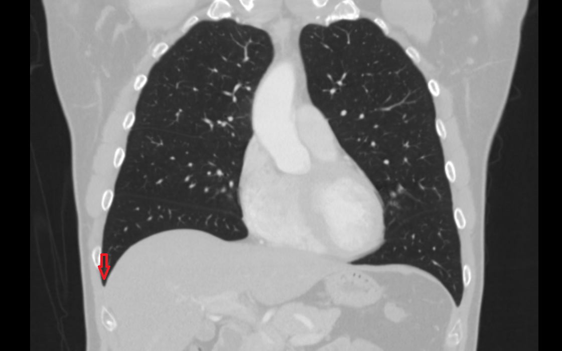 Right costophrenic angle ct Anatomy, Location and Imaging Appearance
