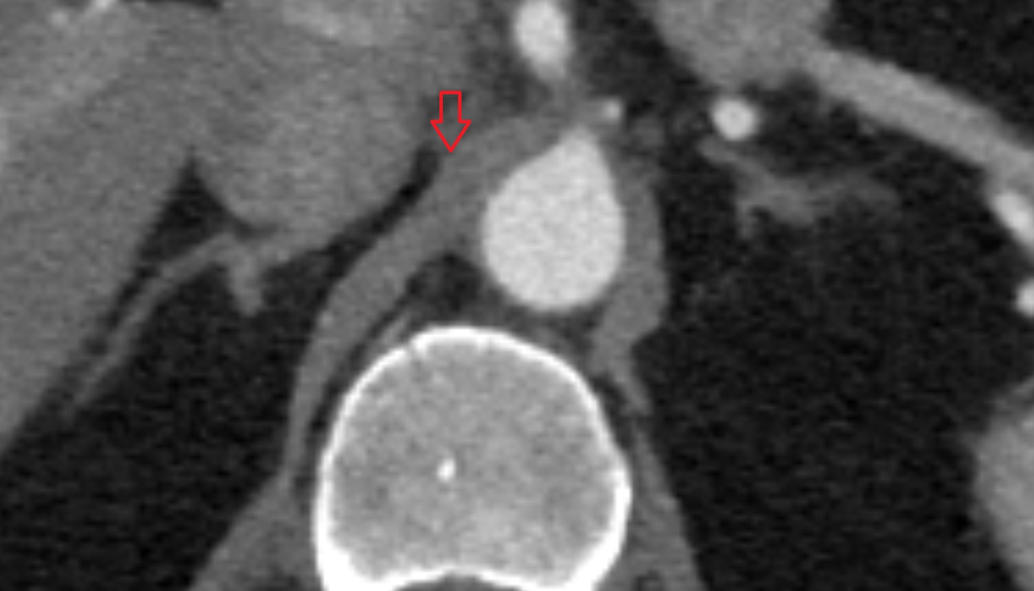 Right crus of diaphragm  anatomy CT axial image -img-00000-00000