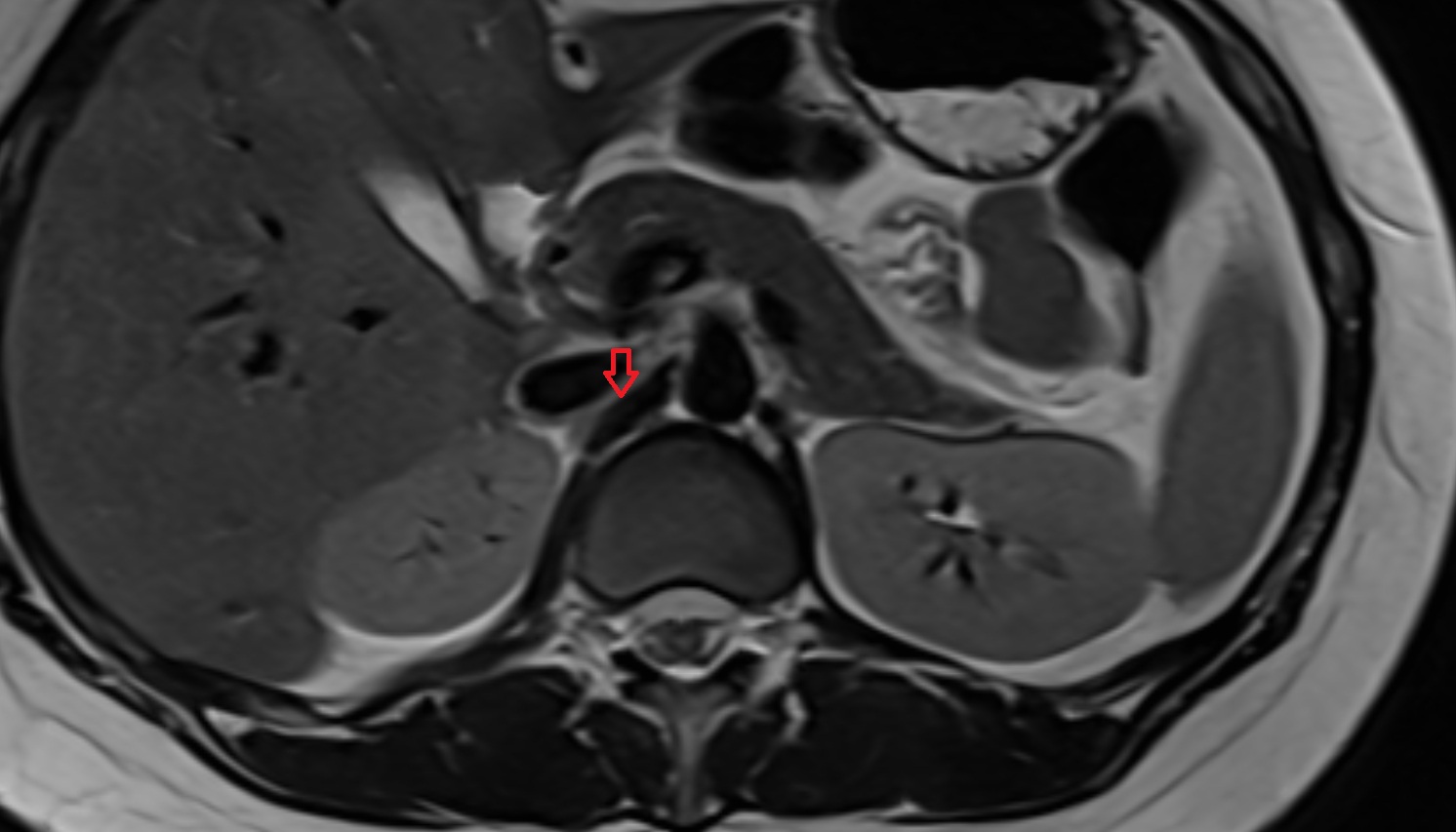 Right crus of diaphragm  anatomy MRI axial image -img-00000-00000