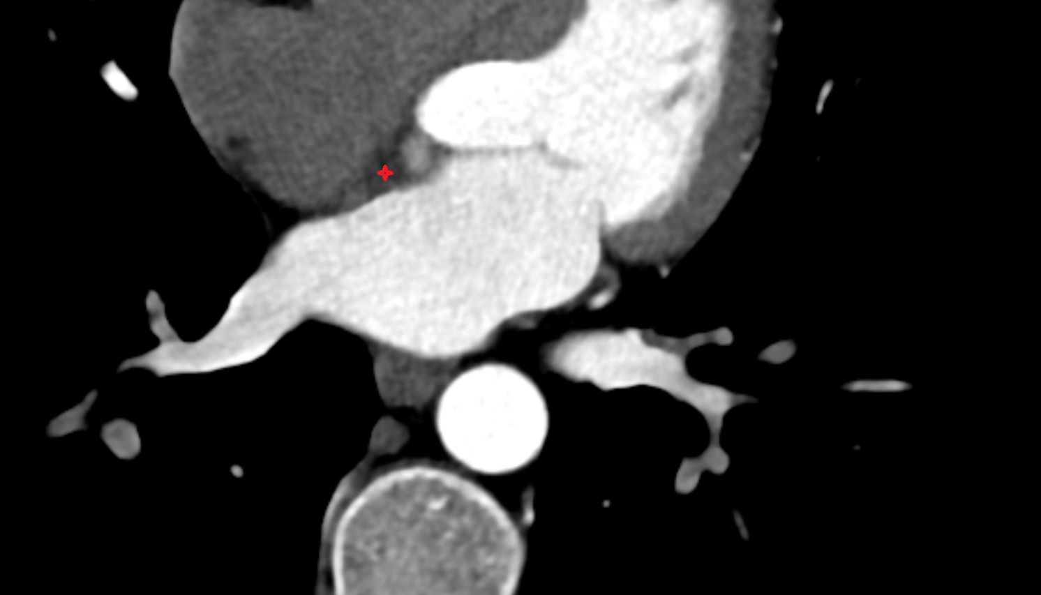 Right fibrous trigone  CT axial   image -img-00000-00000