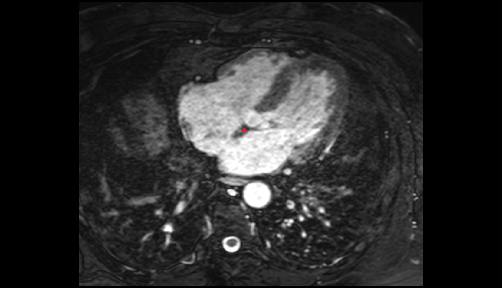 Right fibrous trigone mri image