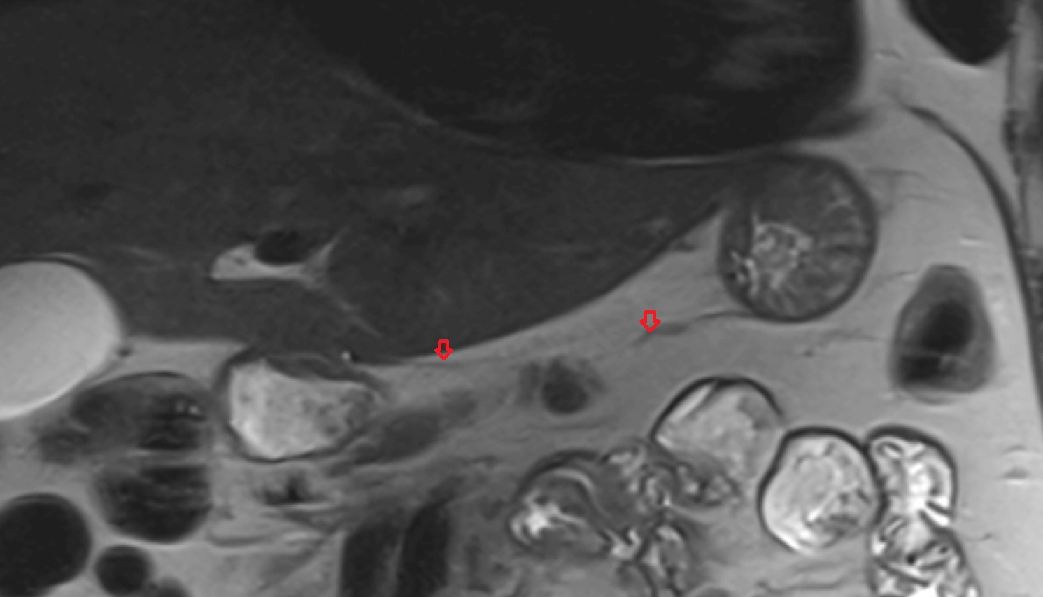 Right gastric artery MRI coronal  anatomy  image