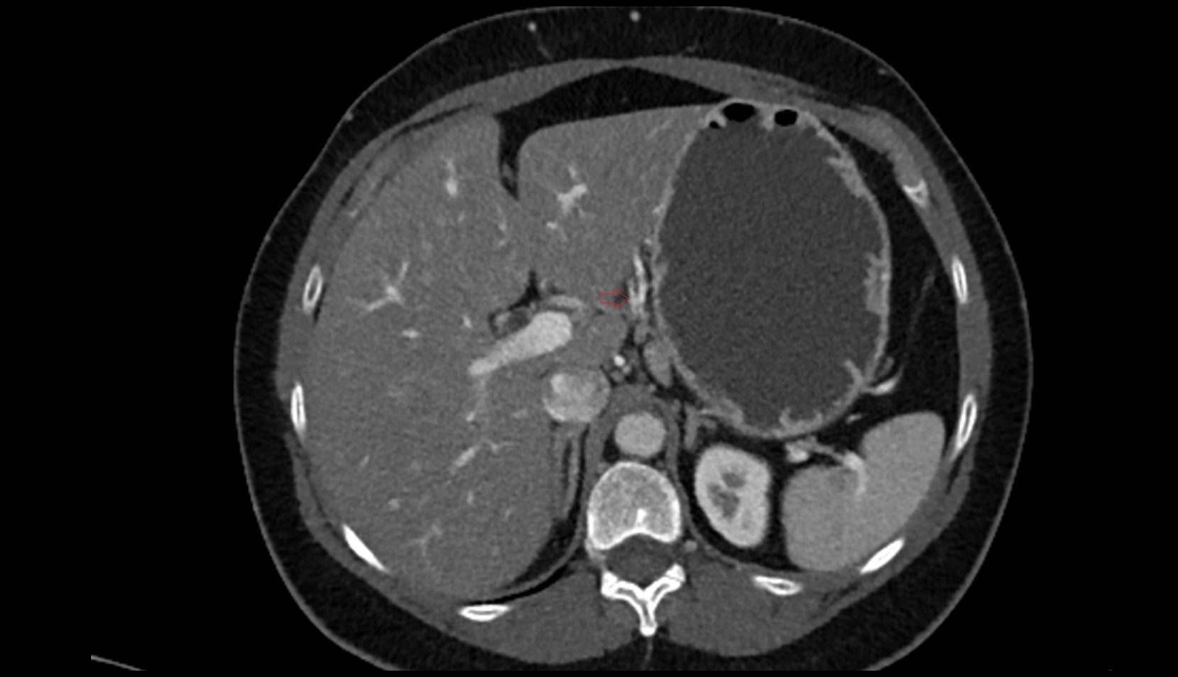 Right gastric artery ct axial image