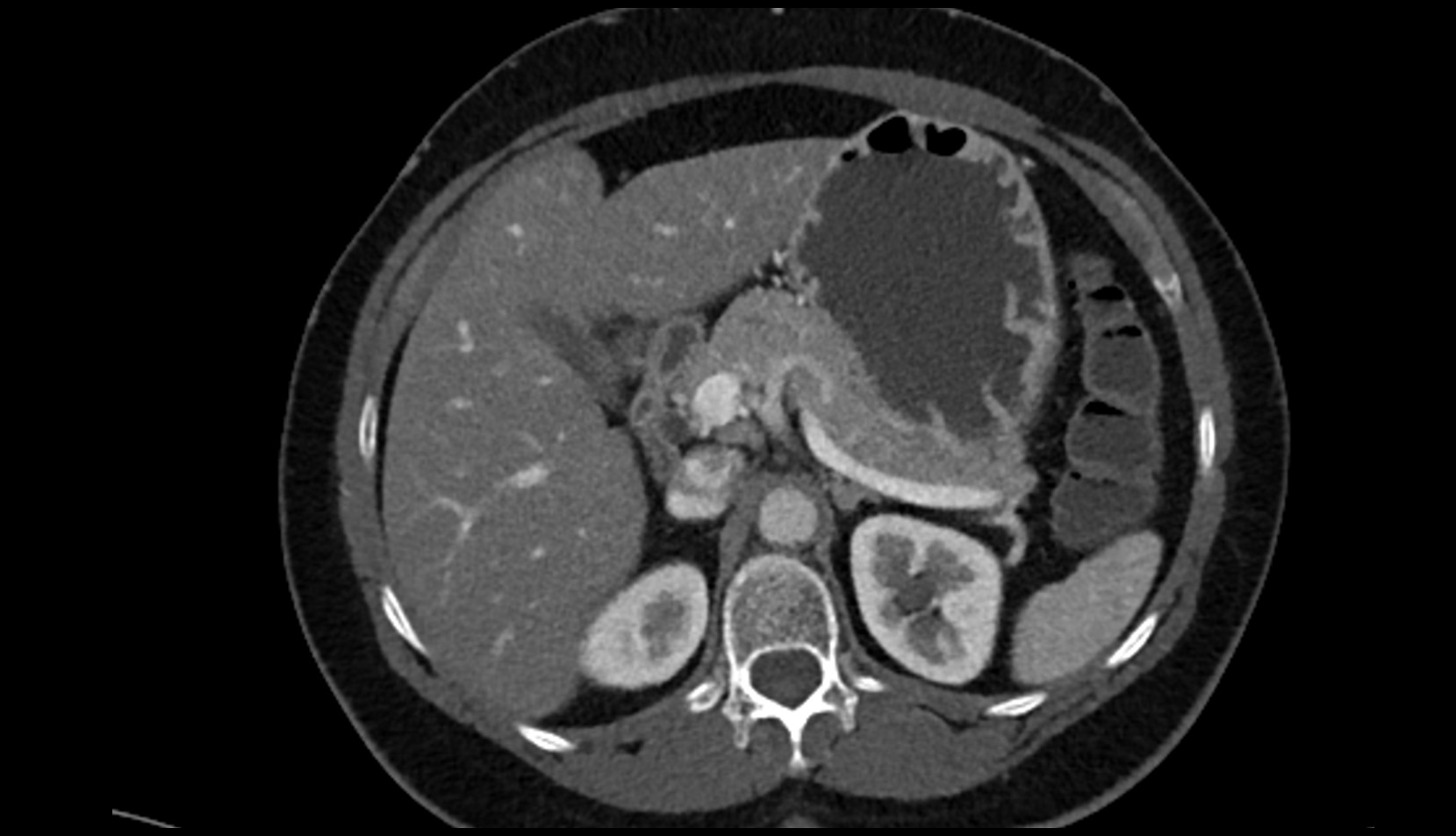 Right gastric artery ct axial image 1