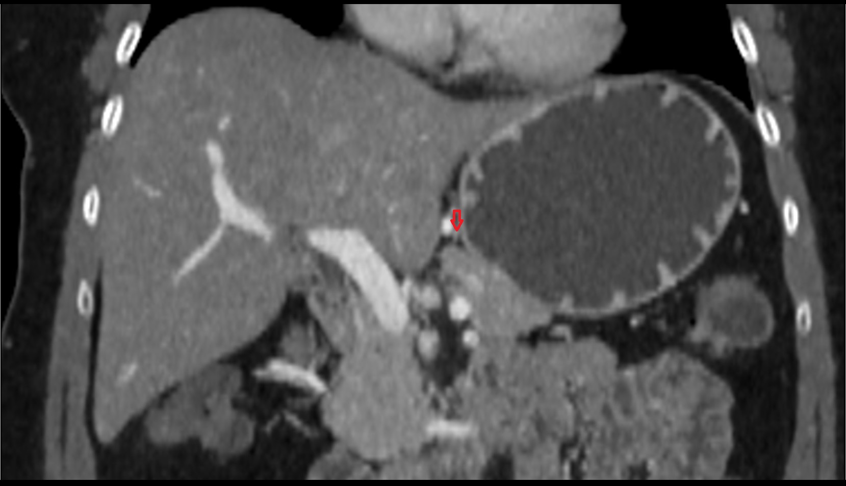 Right gastric artery ct coronal image