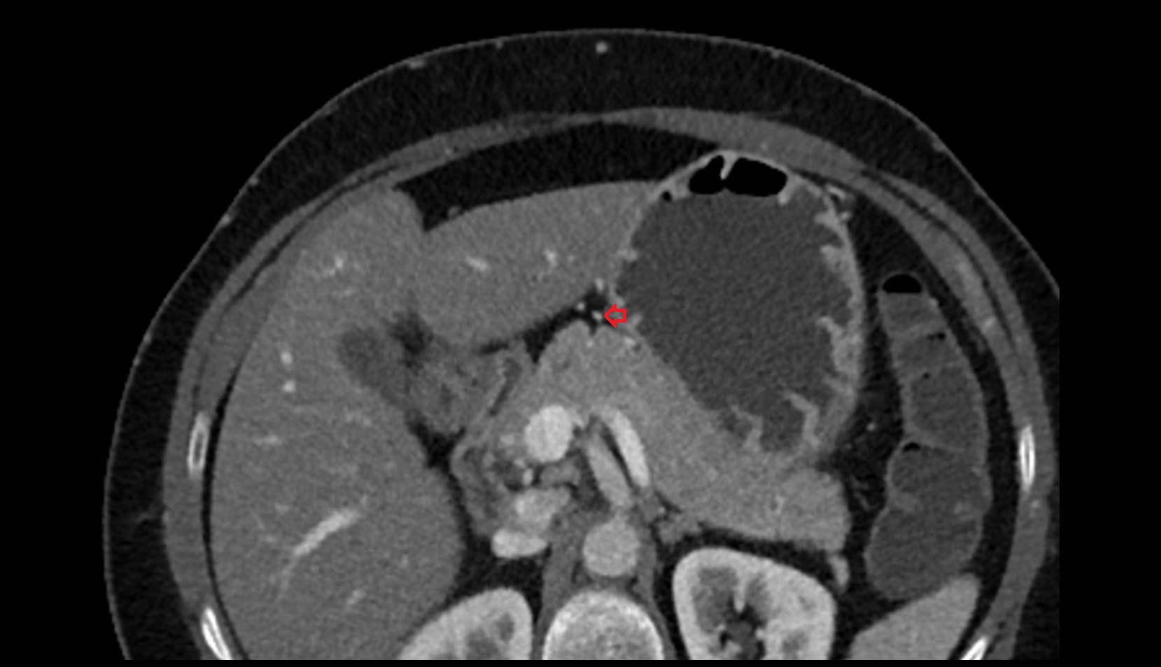 Right gastric vein CT axial image 1