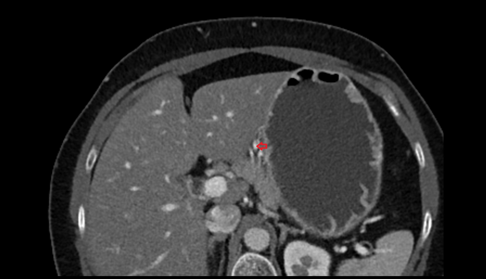 Right gastric vein CT axial image 2